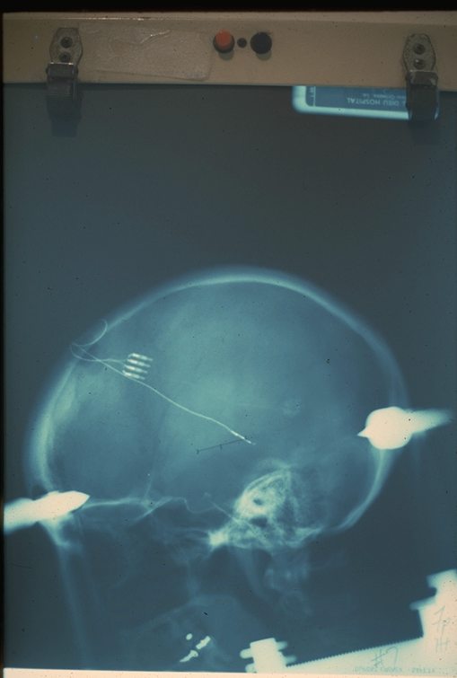 Episode 78 - Medtronic neurostimulation history, image 2